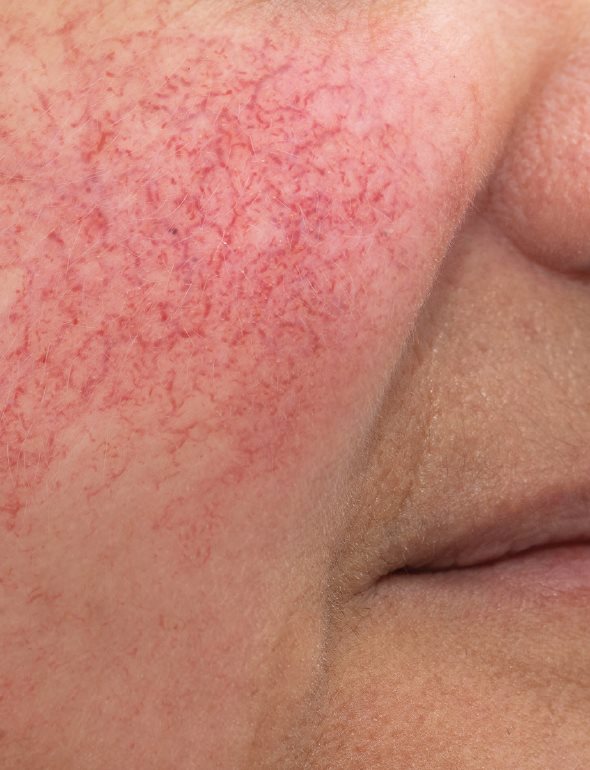 Rosacea